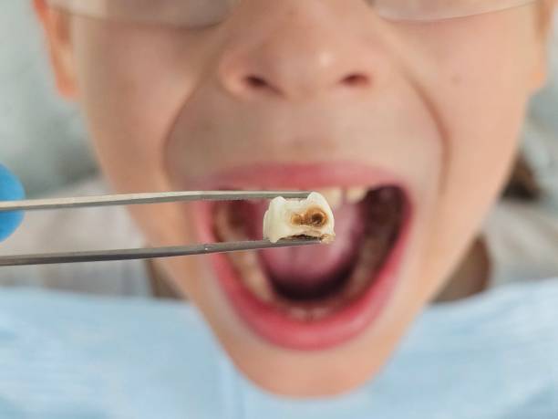 Best Emergency Tooth Extraction in Delafield, WI